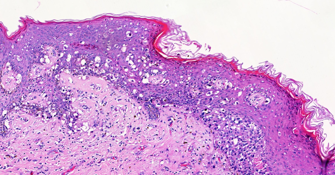 Paget disease of breast with dermal invasion KiKo XP